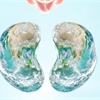 What in the World Is Chronic Kidney Disease?